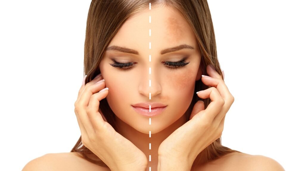 Pigmentation Facial